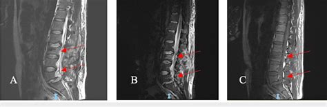 Findings of an L3 fracture with posterior ligamentous complex injury... | Download Scientific ...