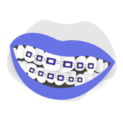 Can Braces Correct Teeth Crowding In Adults Smile Prep