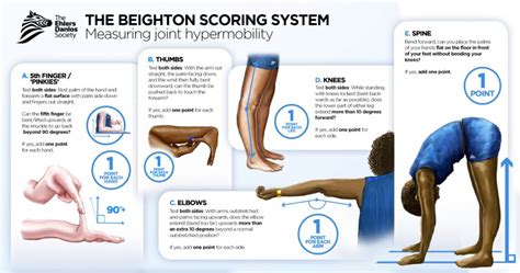 The Beighton Scoring System Dr David Cunnington