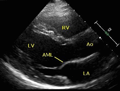 Basic echocardiographic views – All About Cardiovascular System and ...