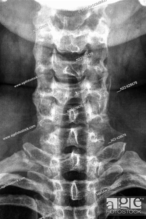 Cervical vertebrae X-ray, Stock Photo, Picture And Rights Managed Image ...