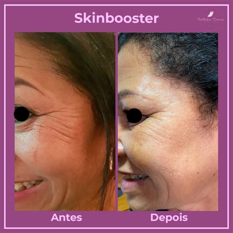 Skinbooster Nathalia Cionini