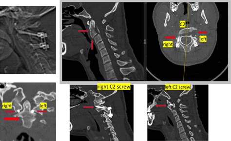 Ct Images Revealing Status Post The Initial Surgery Performed At