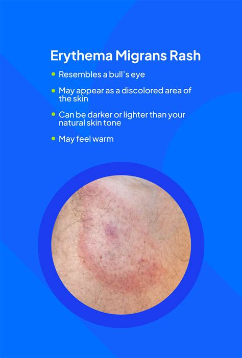 Lyme Disease Tick Bite Rash