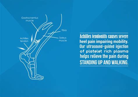 Medicating Achilles Tendinopathy Atlas Pain Care