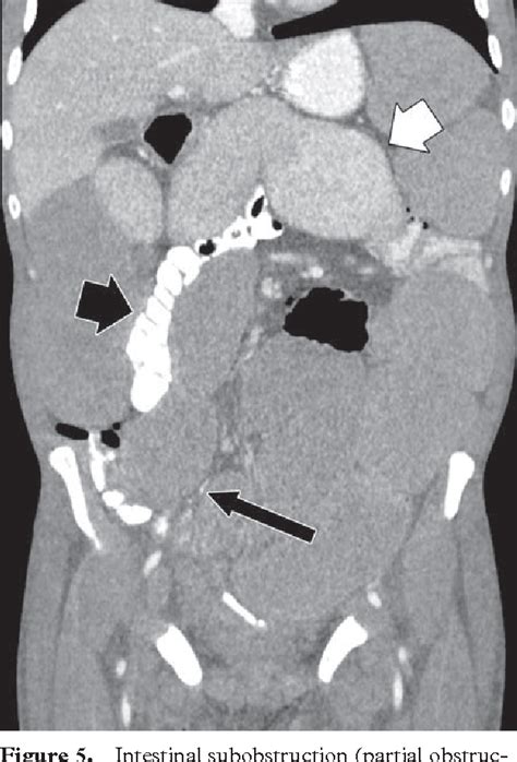 Figure 16 From CT Findings In Urinary Diversion After Radical