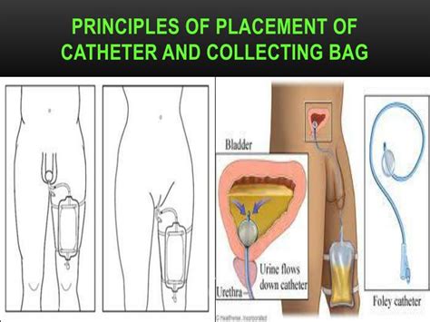 Ppt Urinary Catheter Care Skills In Asepsis Powerpoint Presentation