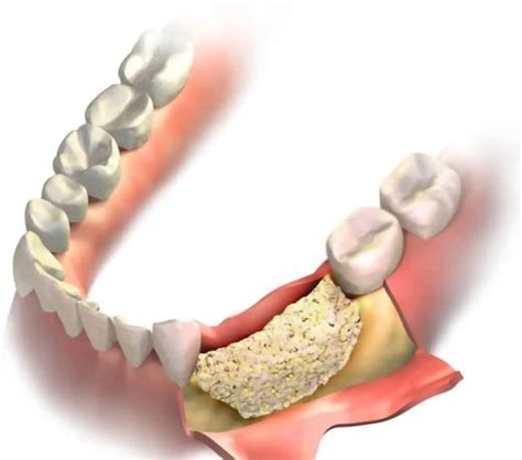 Bone Grafting For Dental Implant Types Of Bone Graft