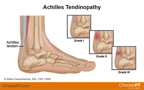 Guide Physical Therapy Guide To Achilles Tendinopathy Choose Pt