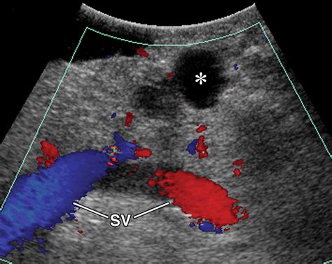 Intraoperative Ultrasonography Of The Pancreas Radiographics