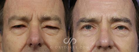 Blepharoplasty Before And After Men