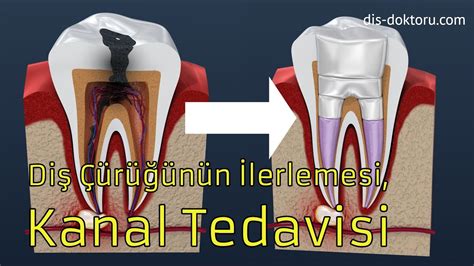 Kanal Tedavisi ve Çürük Diş YouTube