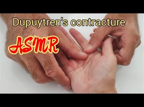 Asmr Hand Massage Dupuytren S Contractyre Asmrtherapy Youtube