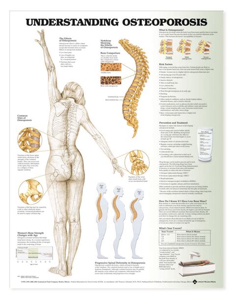 Understanding Osteoporosis | Gezond, Medisch, Biologie