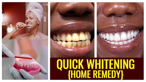 How To Whiten Yellow Teeth Quick Method Live Demonstration Home Remedy Youtube