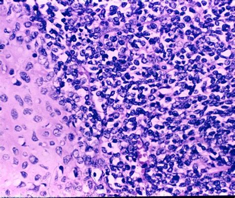 Chondrosarcoma Histology