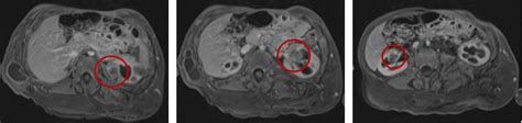 Bilateral Wilms Tumor In Cloves Syndrome Urology