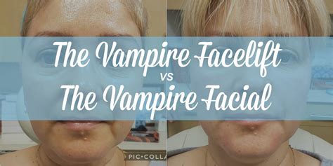 Vampire Facelift Vs Vampire Facial What S The Difference Beverly