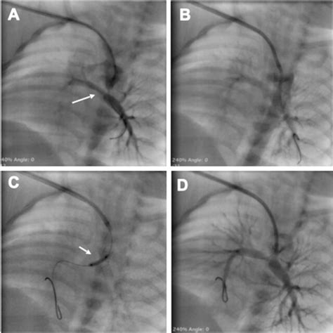 A Ductal Angiogram Showing Underfilled RPA White Arrow Due To Origin