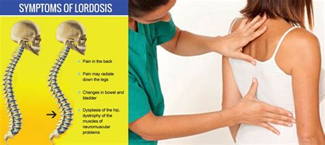 Lumbar Lordosis Straightening