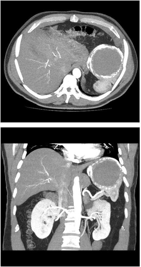 Ct Scan Of The Abdomen Axial View Showing A Large Splenic Cyst With Download Scientific