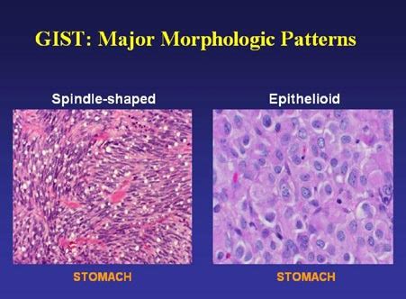 Diagnosis Pathology Results GIST Support International