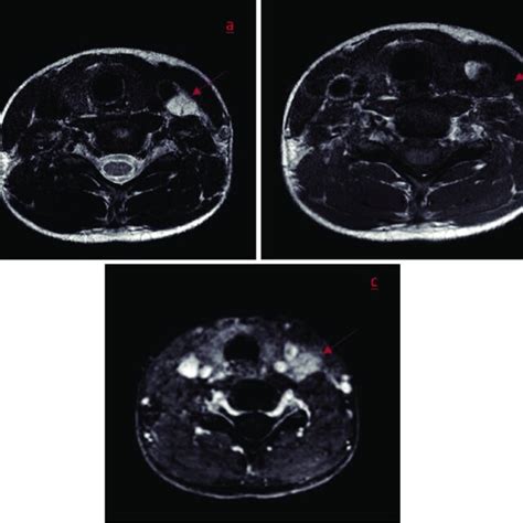 A B Coronal T2 Weighted Dixon Fat Suppressed Image And A Coronal T1w