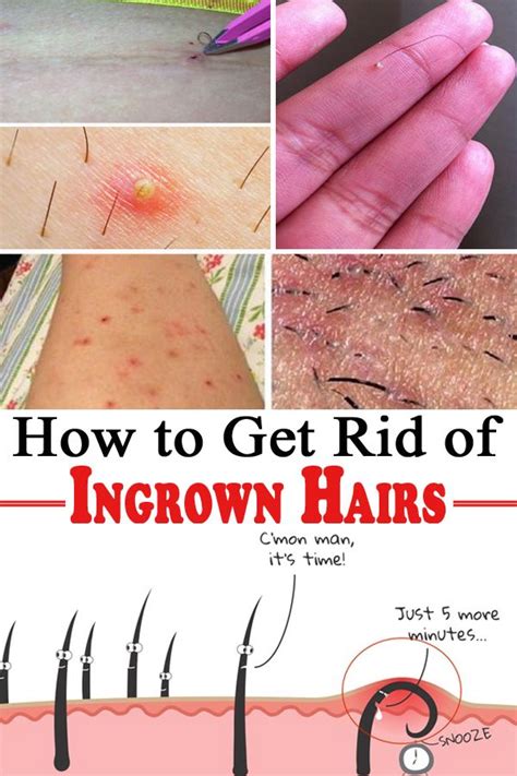 How To Get Rid Of Ingrown Hairs Ingrown Hair Treat Ingrown Hair Infected Hair Follicle