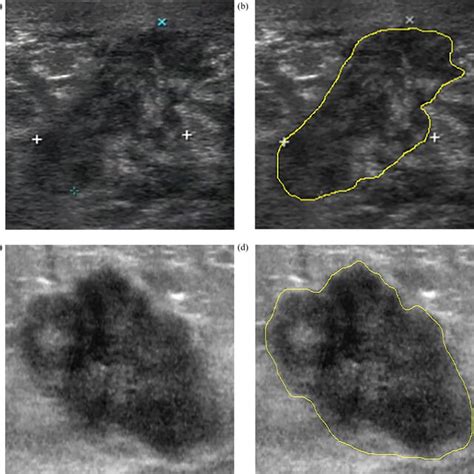 Pdf Prediction Of Axillary Lymph Node Metastatic Load Of Breast