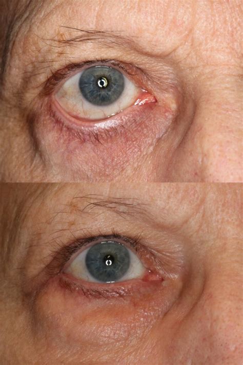 Blepharoplasty Portland Eyelid Surgery Portland Ehnpc