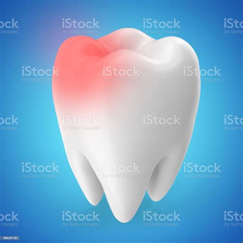 치 통 개념 블루 색조에 고립 된 카 리에 스 개념 3 차원 렌더링 부작용에 대한 스톡 사진 및 기타 이미지 부작용 치아
