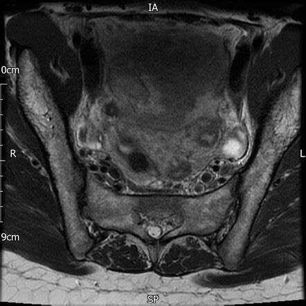 Unicornuate Uterus Radiology Case Radiopaedia Org