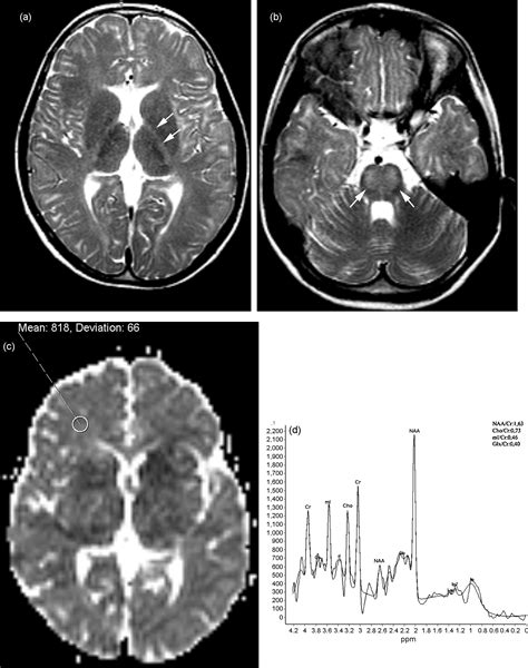 Diagnostic Value Of Proton MR Spectroscopy And Diffusion Weighted MR