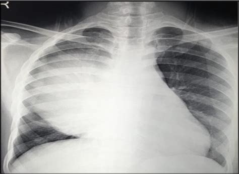 Figure 1 From Pulmonary Blastoma A Case Report Of A Rare Lung Tumour