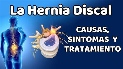 LA HERNIA DISCAL Causas signos y síntomas diagnóstico y tratamiento