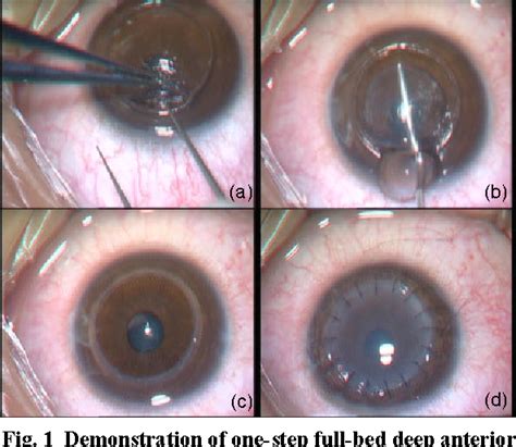 Figure 1 From Long Term Comparison Of Full Bed Deep Anterior Lamellar Keratoplasty And