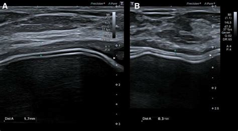 Comparative B Mode Ultrasound Images A The Image On The Left Depicts