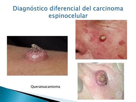 Carcinoma Basocelular Y Espinocelular Ppt