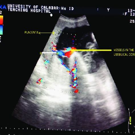 Color Flow Doppler Image Showing The Placental Thickness Measurement Download Scientific