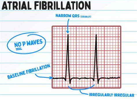 AFIB RVR on EKG: Management of Atrial Fibrillation | Health And Willness