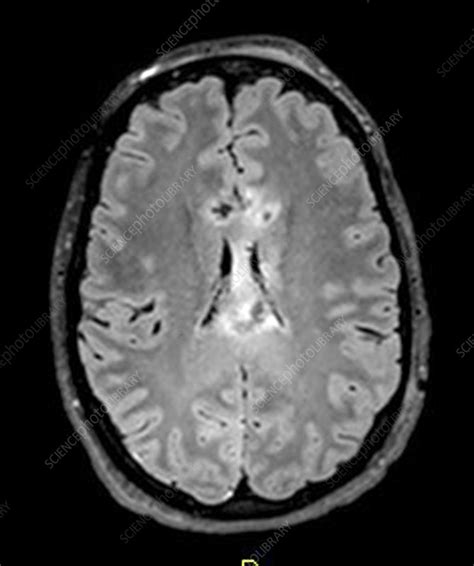 Severe Traumatic Brain Injury MRI Stock Image C027 1724 Science