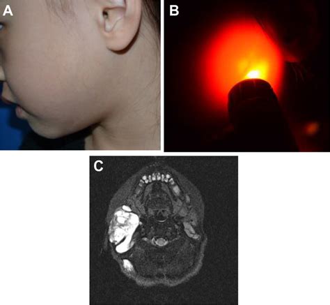 Lymphatic Malformation Notes A And B Soft Nontender Mass On Cheek