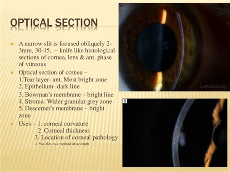 Slit Lamp Biomicroscopy Of Eye