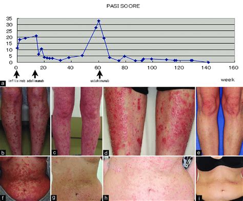 A Psoriasis Area And Severity Index PASI Scores Throughout The Time