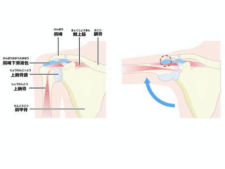 Free Vectors | shoulder impingement syndrome