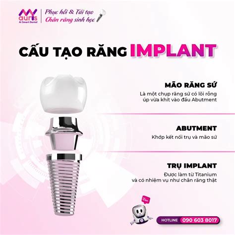 Bảng giá trồng răng implant Nha Khoa My Auris