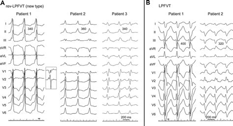 Surface 12 Lead ECG During Reverse Type LPFVT New Type And LPFVT