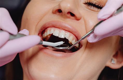 Qu Materiales Se Usan Para Empastar Una Caries Cl Nica Dental