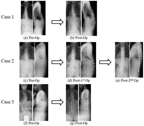 Spinal Deformity In Ehlers Danlos Syndrome Focus On