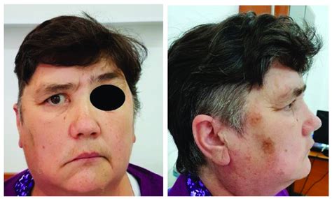 Immediate Postoperative Appearance Of A Patient With Preoperative Right